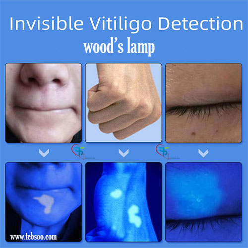 دستگاه تشخیصی wood's lamp